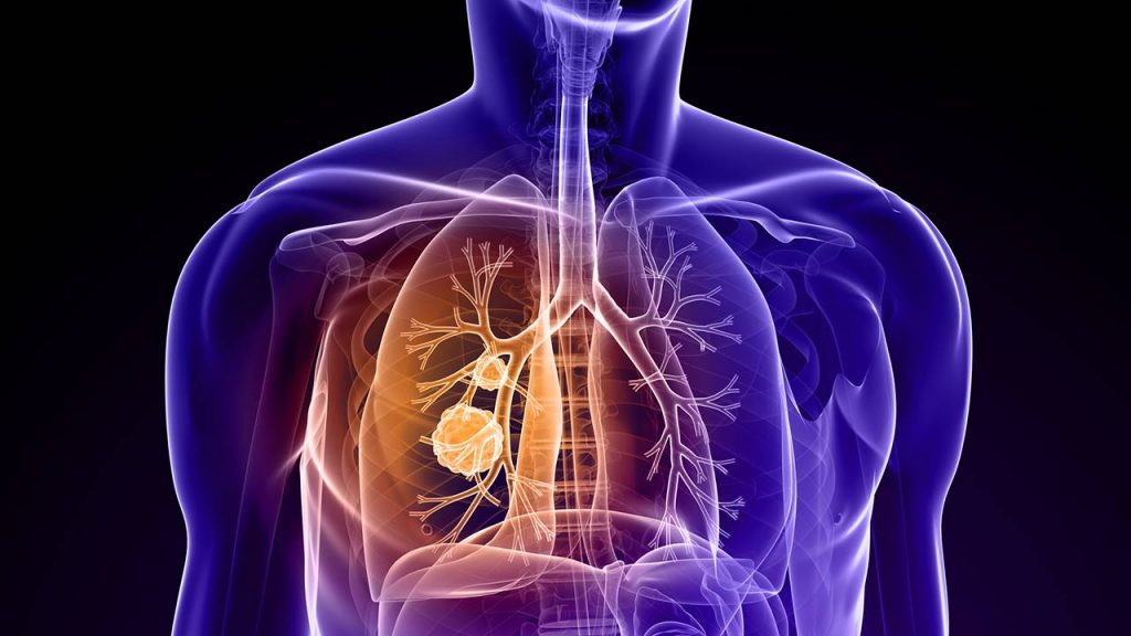 Más de 5.500 andaluces serán diagnosticados este año de cáncer de pulmón, para el que los oncólogos piden un mayor impulso a la prevención y la concienciación social para frenar su crecimiento