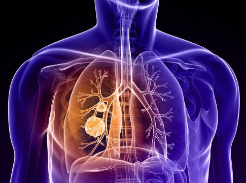 Más de 5.500 andaluces serán diagnosticados este año de cáncer de pulmón, para el que los oncólogos piden un mayor impulso a la prevención y la concienciación social para frenar su crecimiento